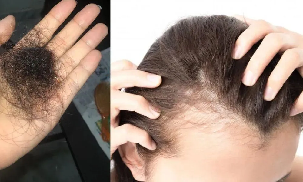 কীভাবে বুঝবেন চুল পড়ছে? প্রতিকার কী?