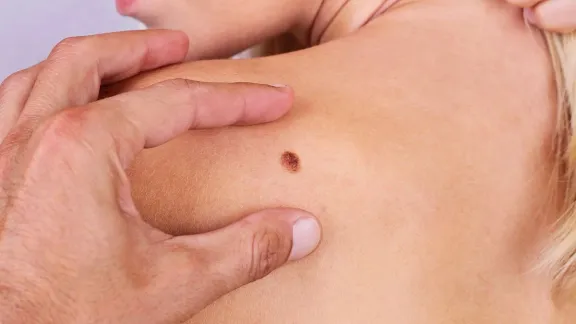 ত্বকের ক্যান্সারে টিকার সাফল্য